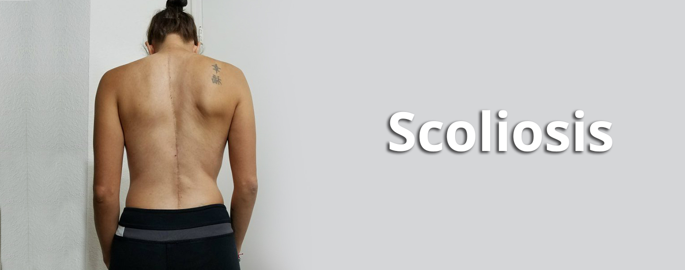 Scoliosis